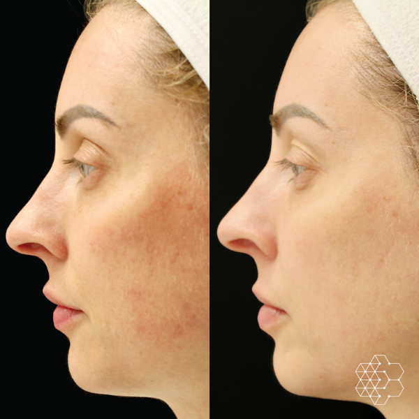 Forever Young BBL™