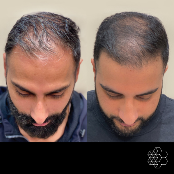 PRP Hair Restoration