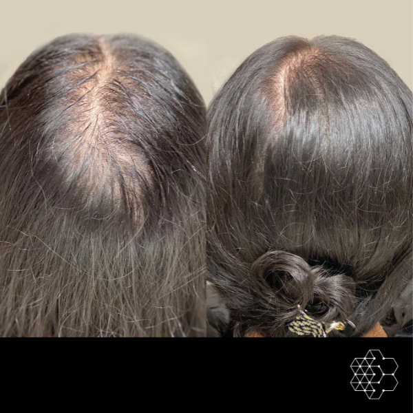 PRP Hair Restoration