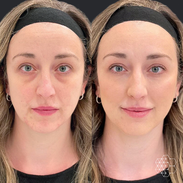 TiredEye™ Treatment