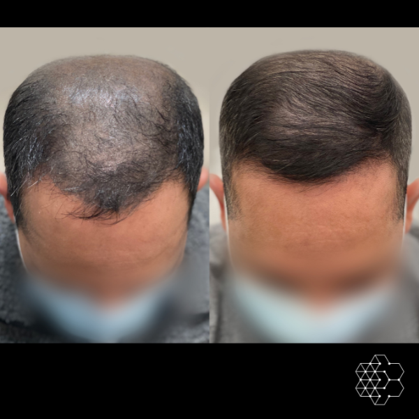 PRP Hair Restoration