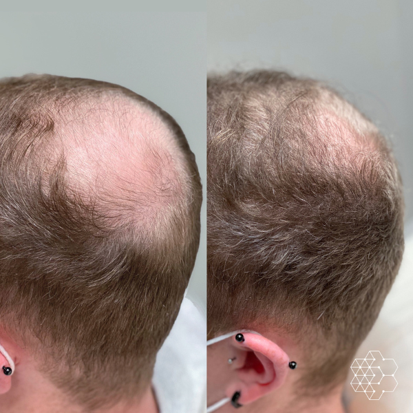 PRP Hair Restoration