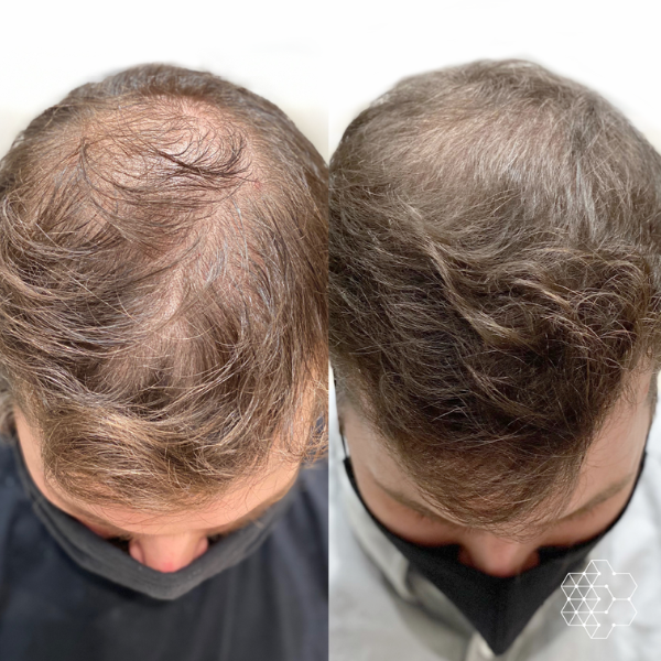 PRP Hair Restoration