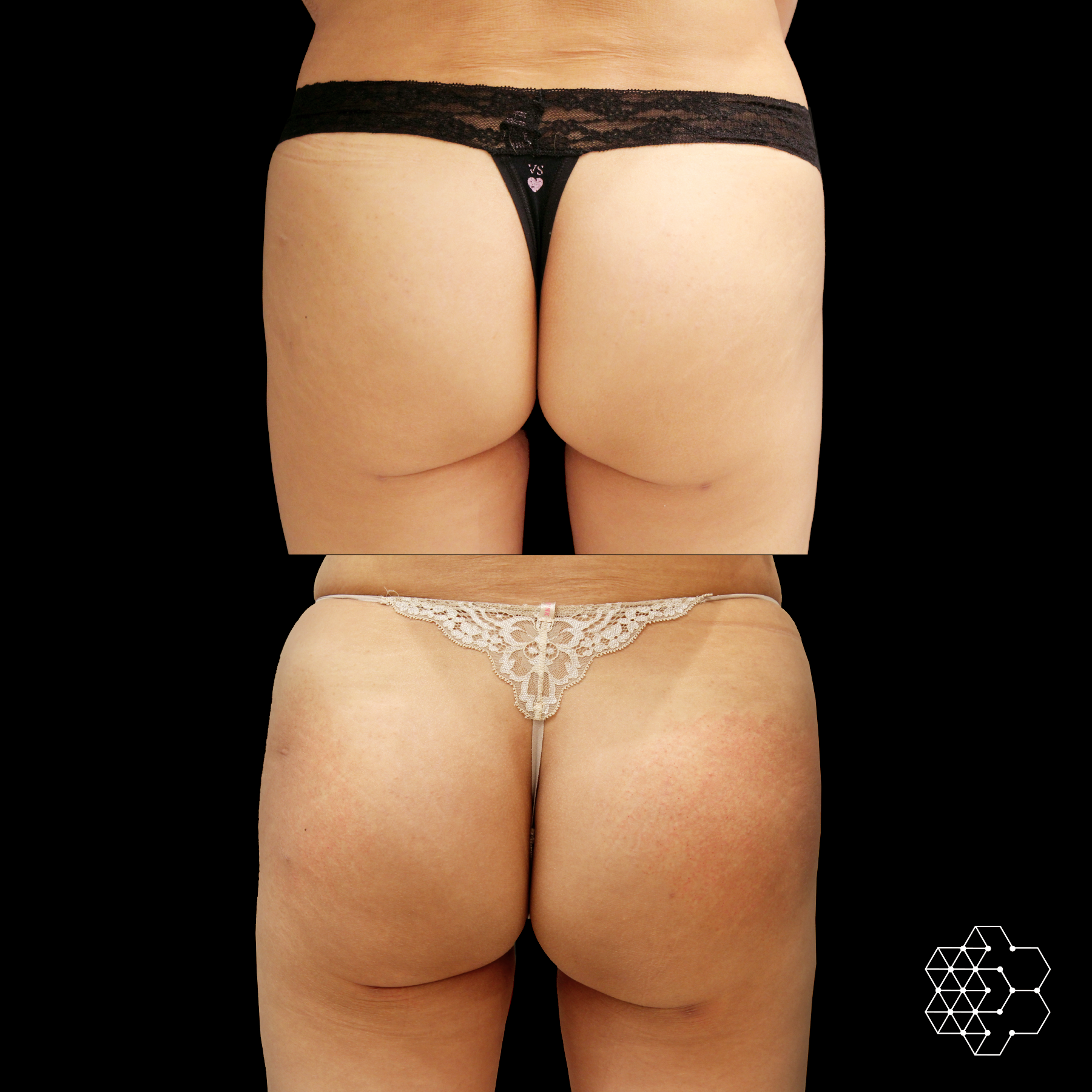 Butt Lift Skin Technique