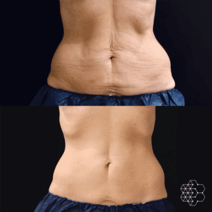 Coolsculpting