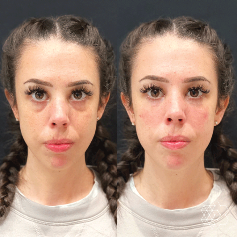 TiredEye™ Treatment