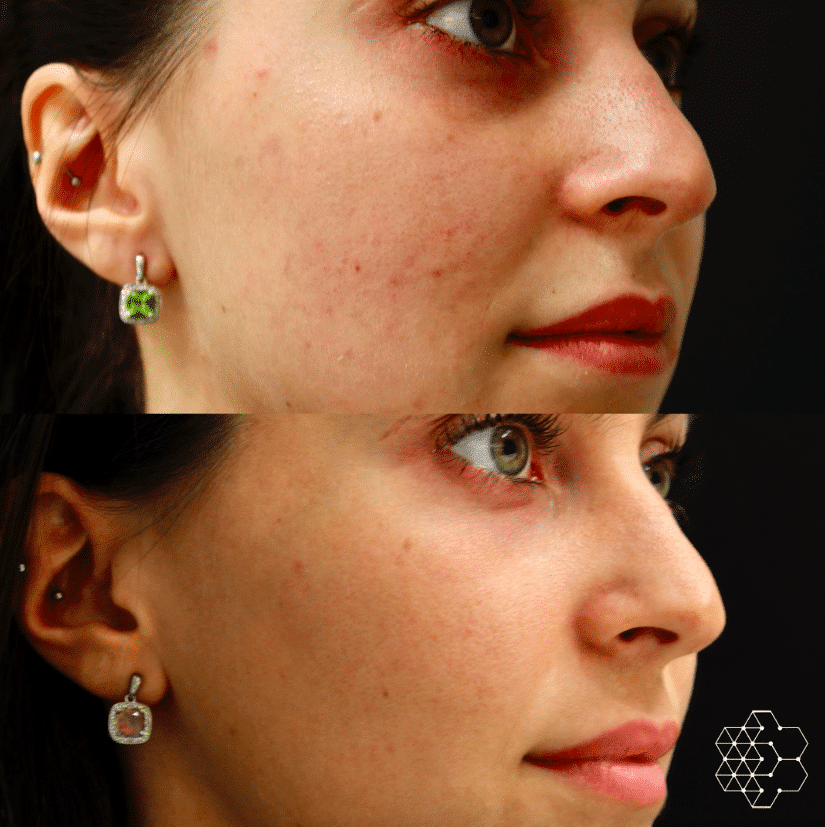 HALO™ Fractional Resurfacing + Forever Young BBL Combo