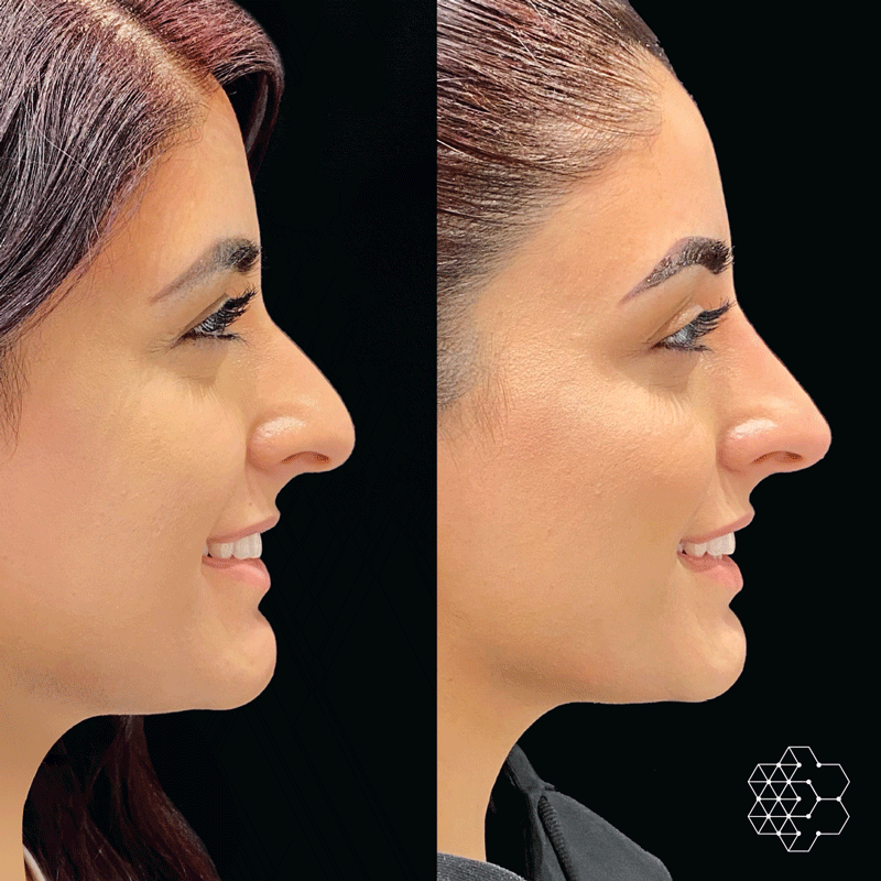 Liquid Rhinoplasty Vs. Surgical Rhinoplasty