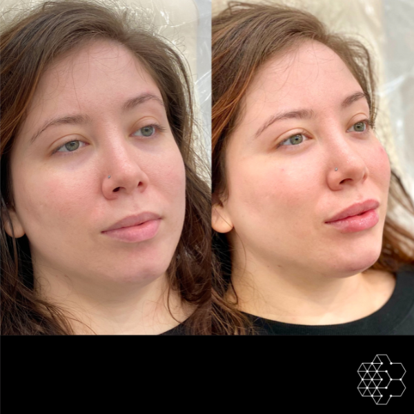 MystLift™ Beautification