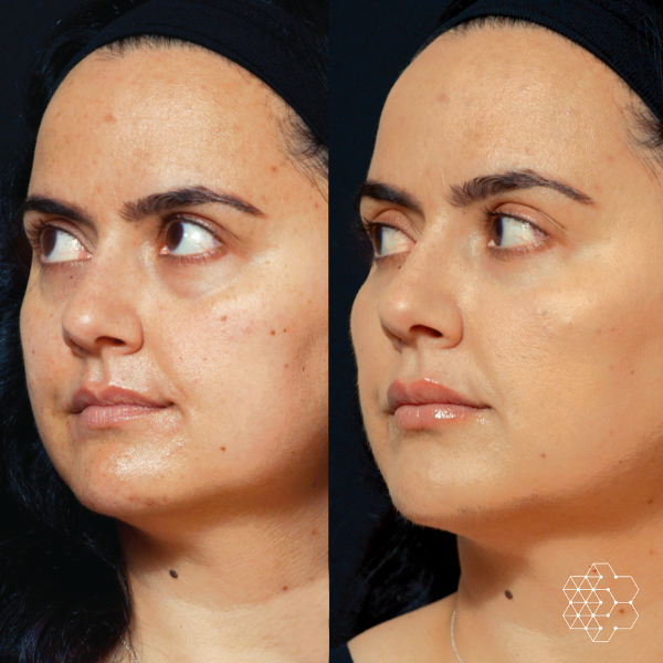 MystLift™ Beautification