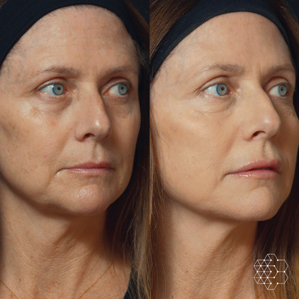 MystLift™ Beautification