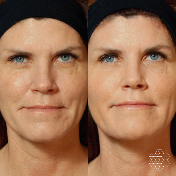 MystLift™ Beautification