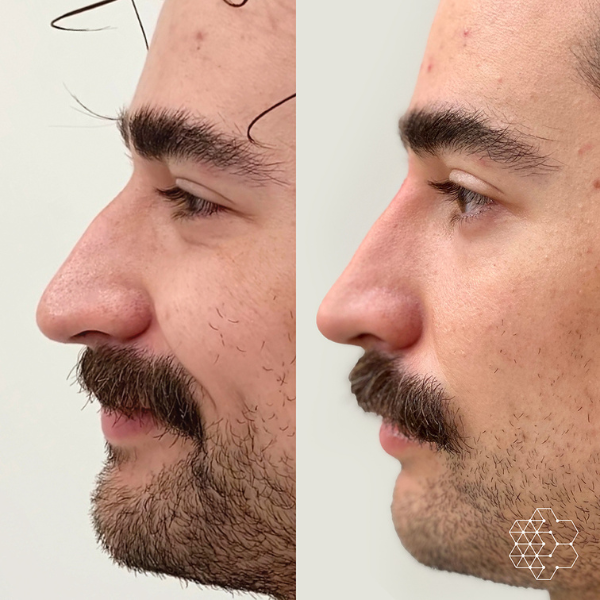 Non Surgical Nose Job