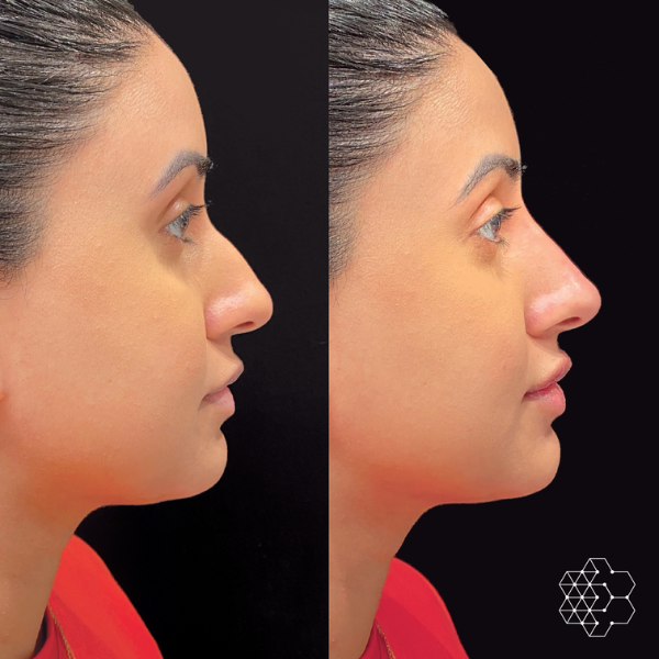 Non Surgical Nose Job