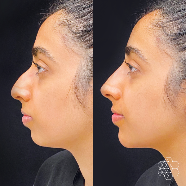 Non Surgical Nose Job
