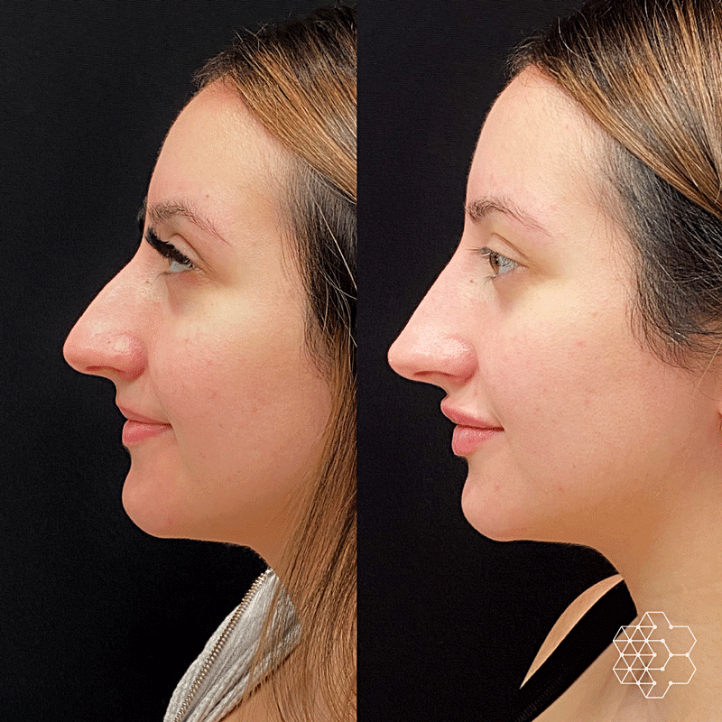 Non Surgical Nose Job