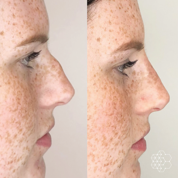 Non Surgical Nose Job