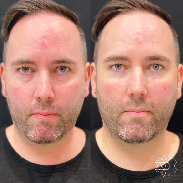 TiredEye™ Treatment