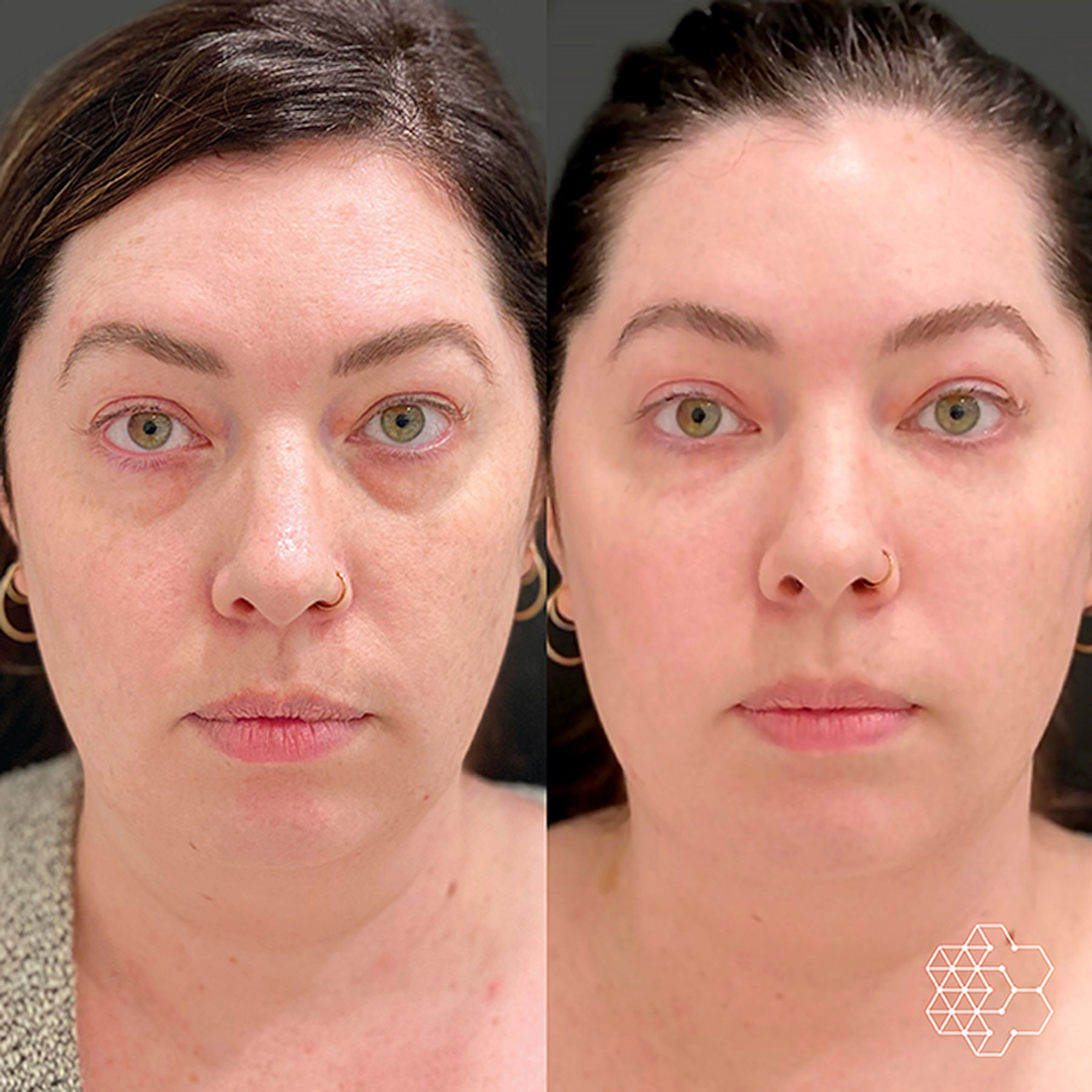 TiredEye™ Treatment