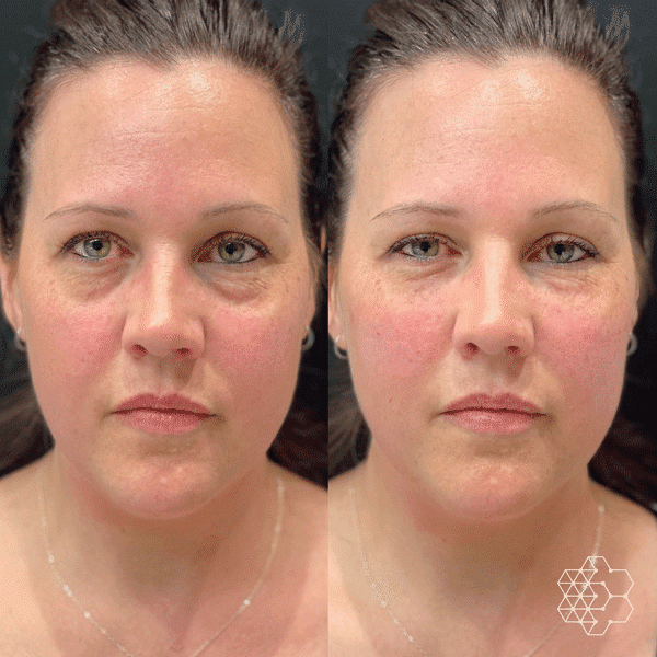 TiredEye™ Treatment