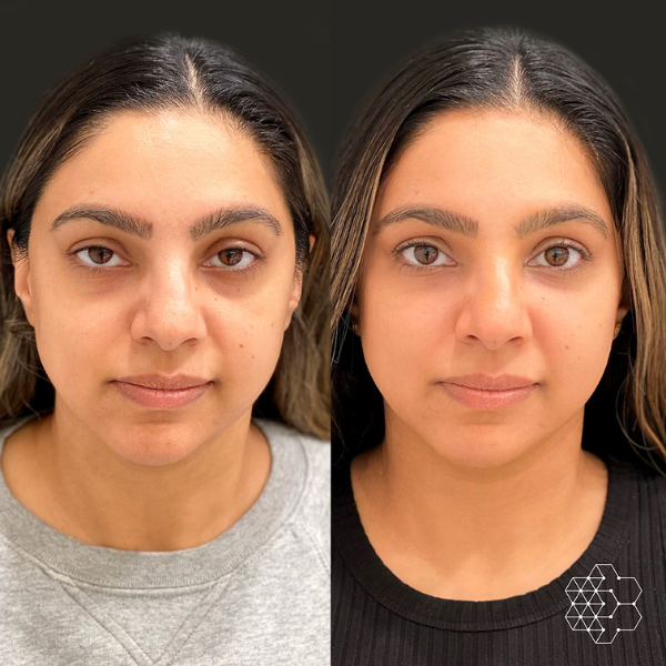 TiredEye™ Treatment